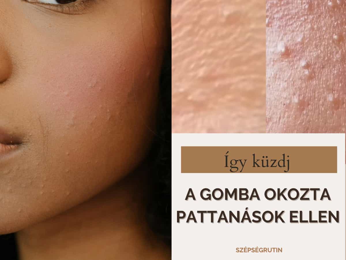 gomba okozta pattanás